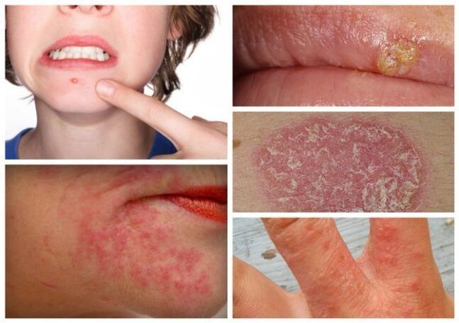 Alahan dan penyakit kulit adalah tanda parasit dalam badan
